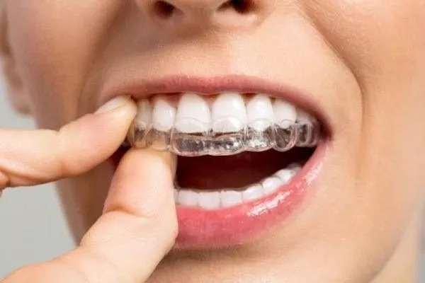 ما هو سعر تقويم الاسنان الشفاف في الرياض واشهر عيادات تقويم الاسنان؟